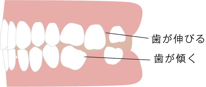 歯は1本欠けると連鎖的にトラブルが広がります